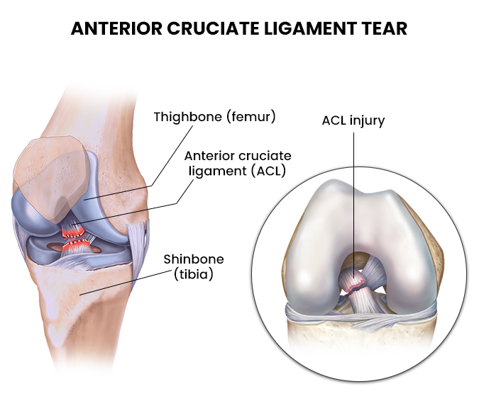 acl tear icd 10