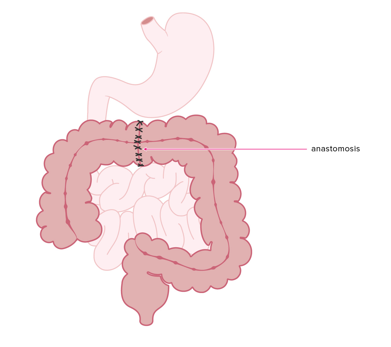 anastomosis