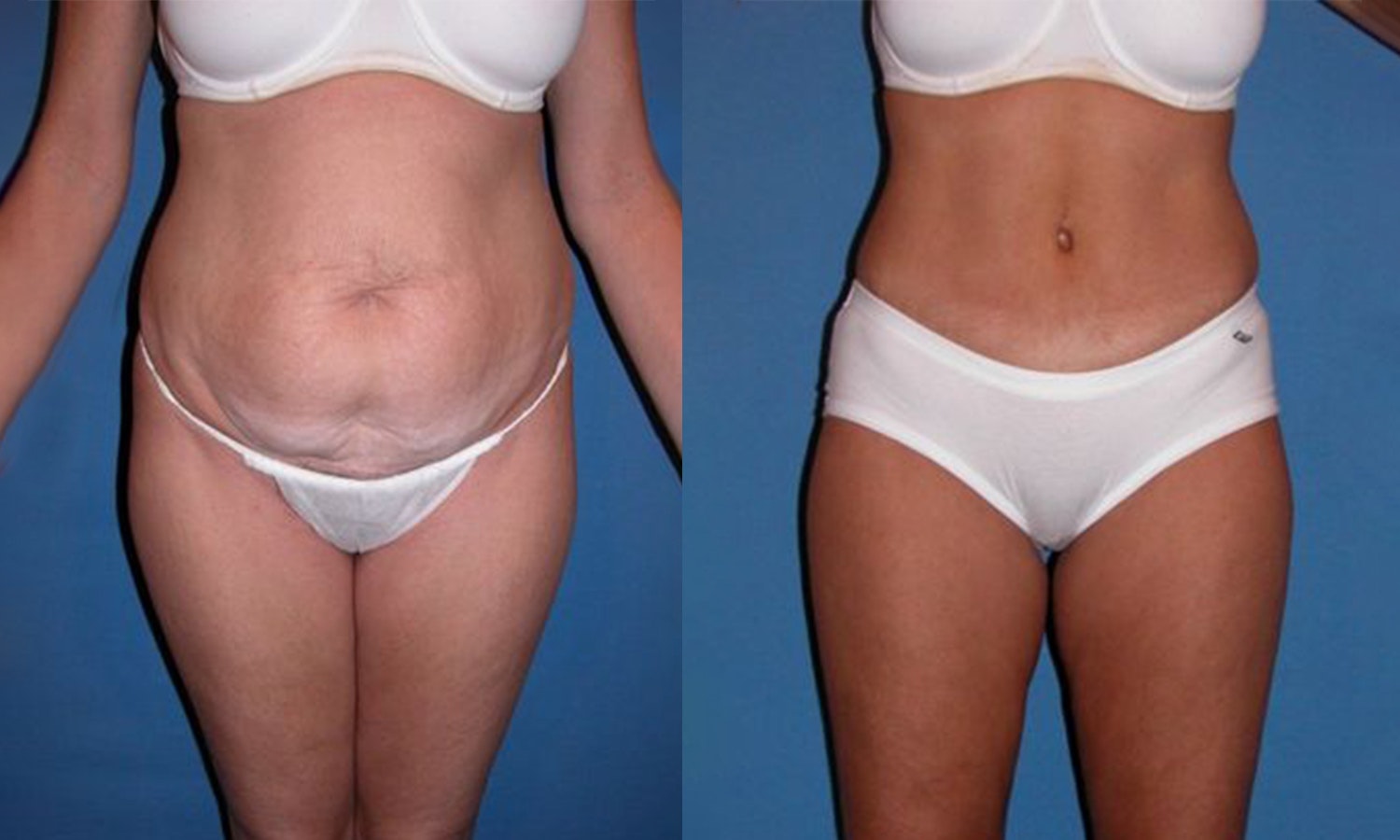 tummy tuck arkansas