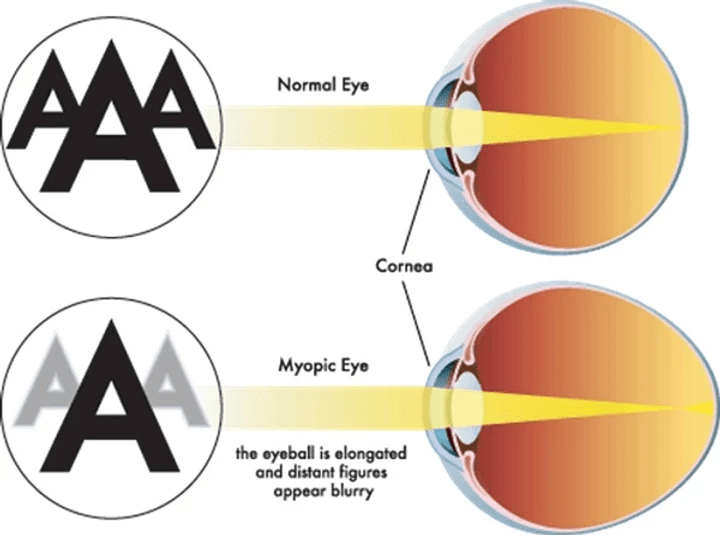 seeing shadows in vision