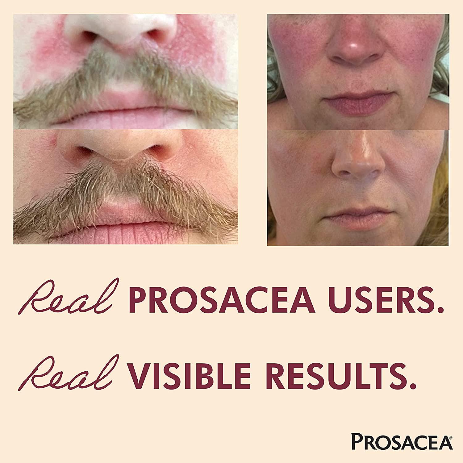 prosacea reviews for rosacea