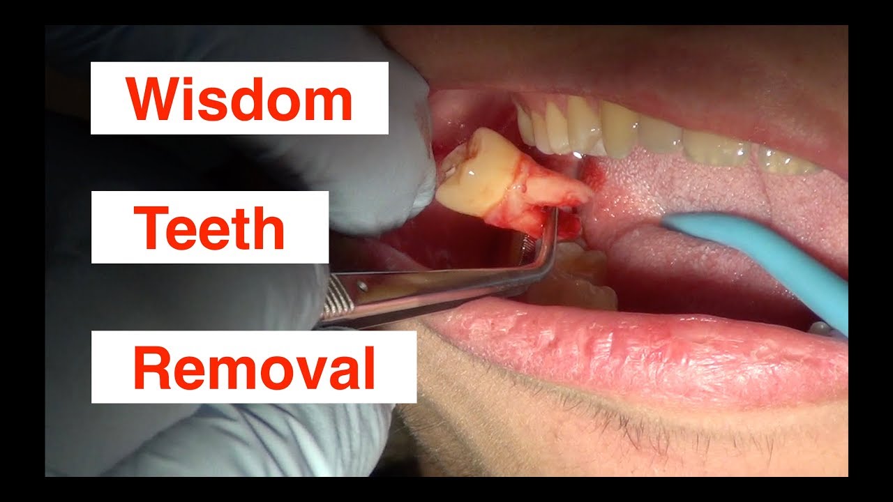 wisdom teeth removal youtube