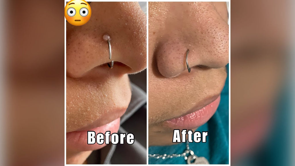 nose piercing keloid