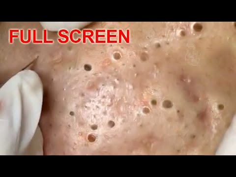 popping spots youtube