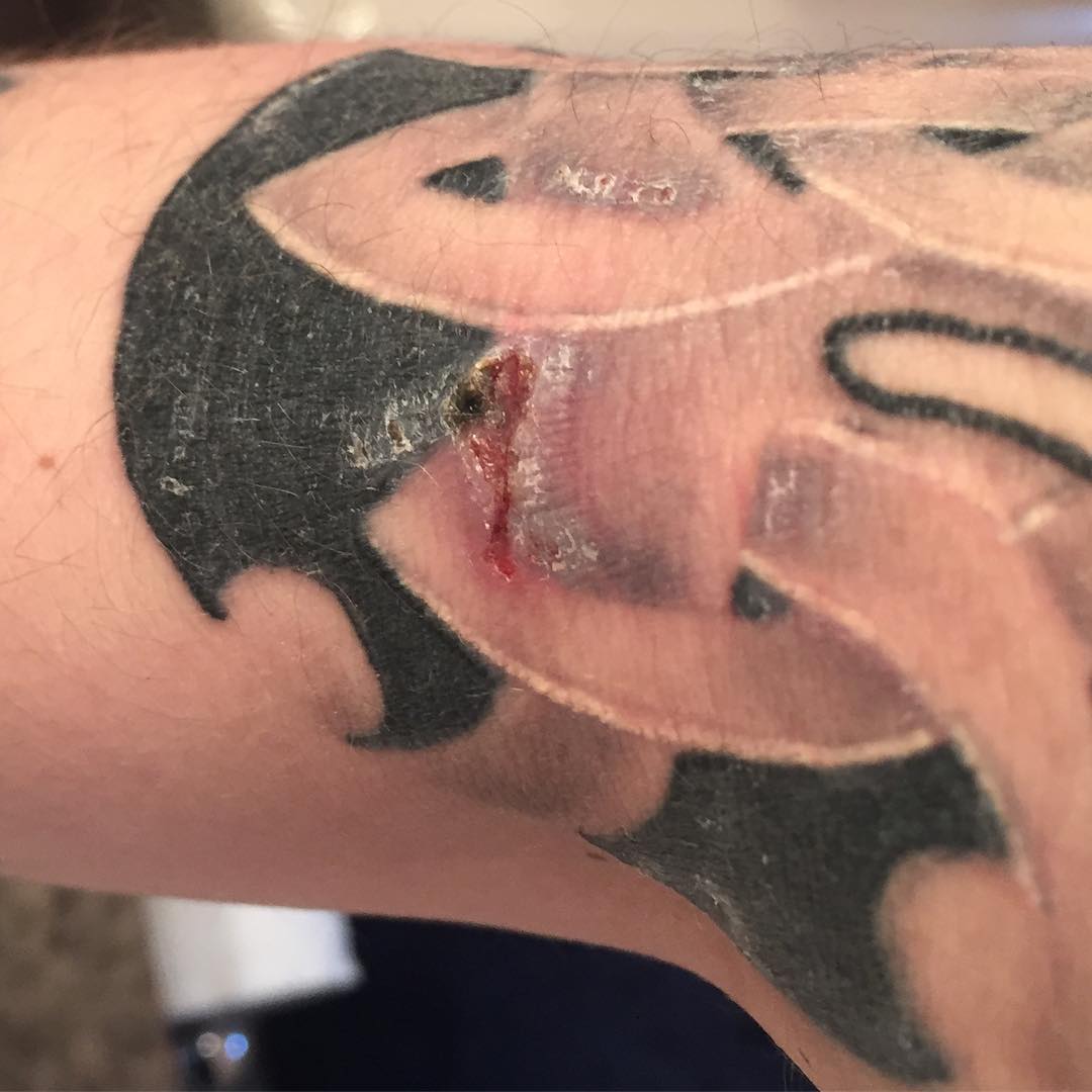 overworked tattoo scar