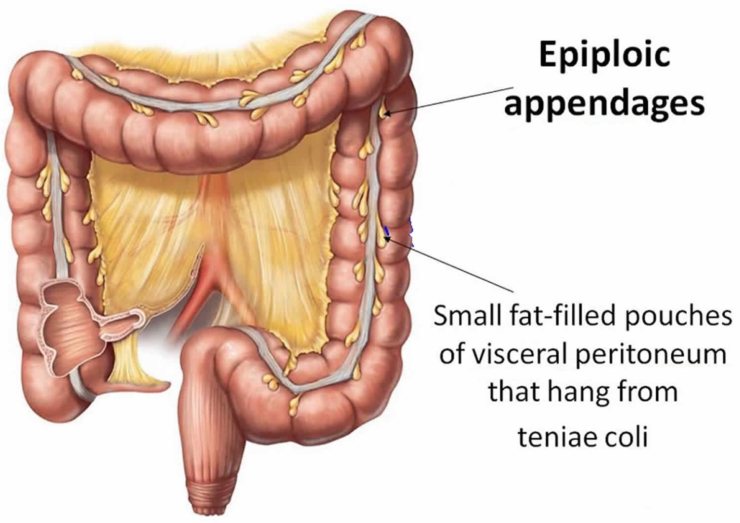 epiploic appendagitis icd 10