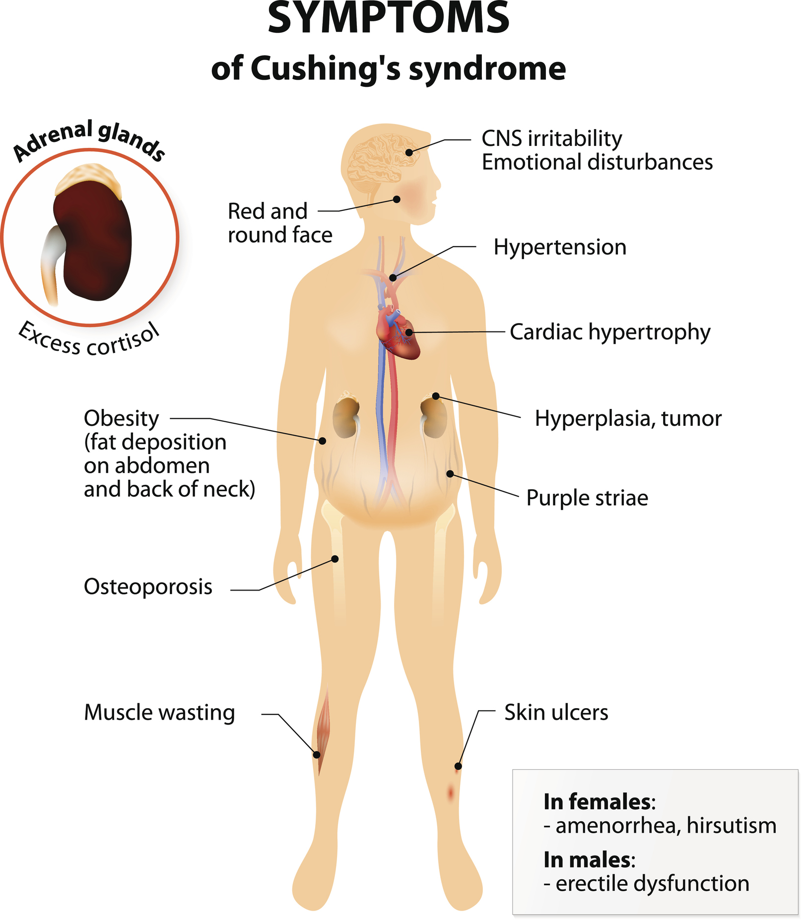 is cushing syndrome treatable