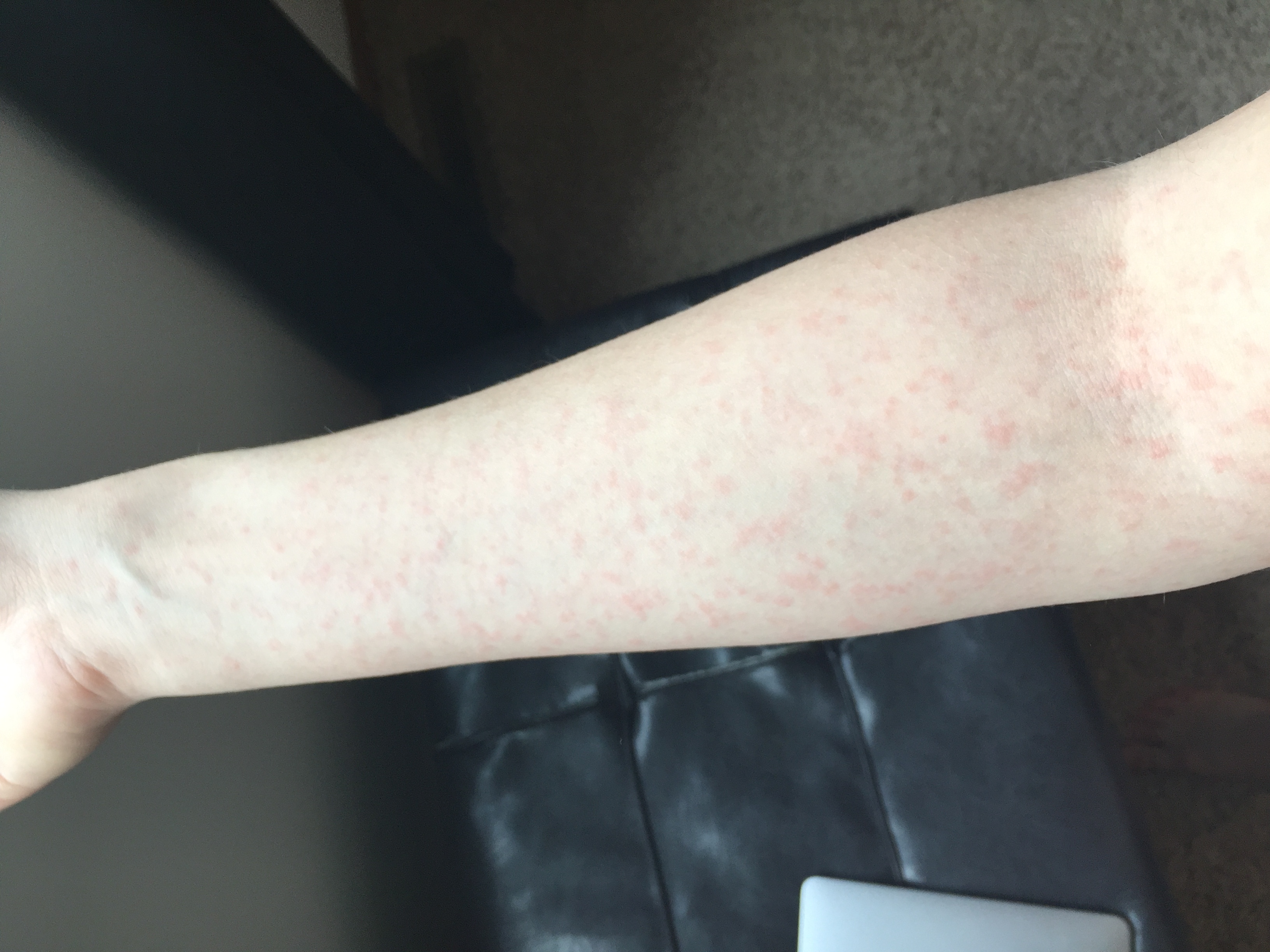 lamotrigine rash photos