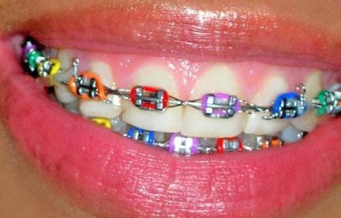 imagenes de brackets bonitos