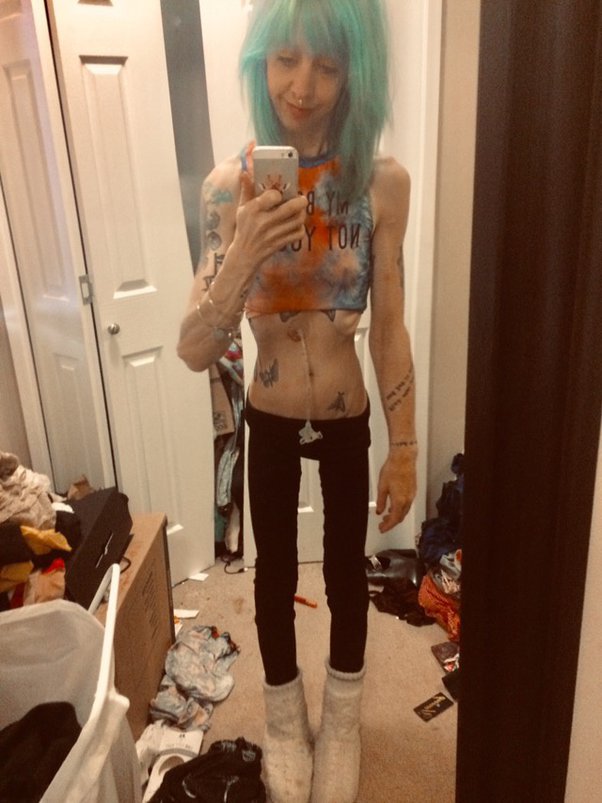 anorexic xxx