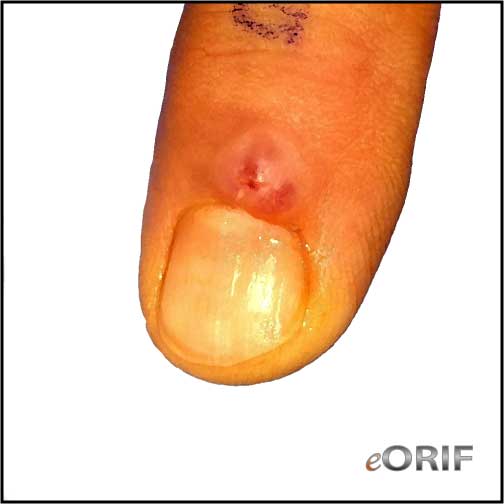 mucous cyst finger icd 10