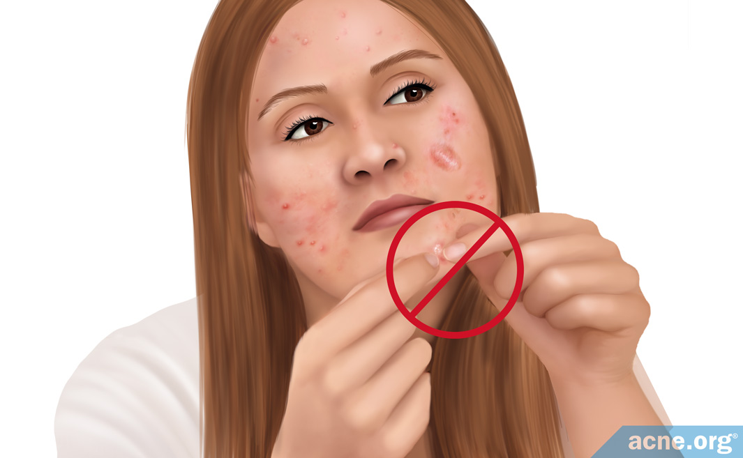 popping cystic acne
