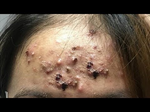 youtube spots and pimples