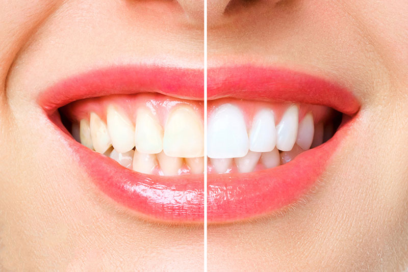 dental teeth whitening treatment maple ridge