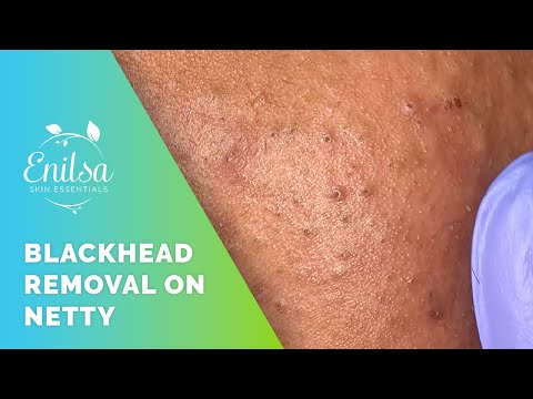 enilsa blackheads