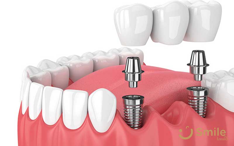 implant fiyatları 2019 izmir