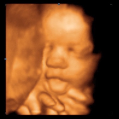 3d ultrasound brampton ontario