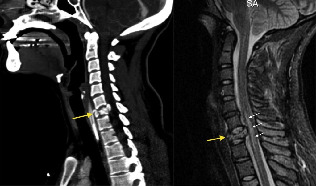 burst fracture radiology