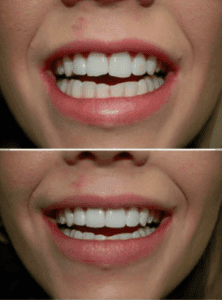 clip on veneers reviews