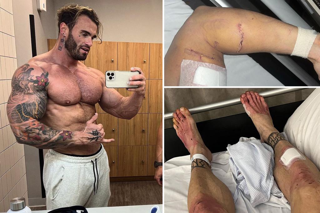 calum von moger injury