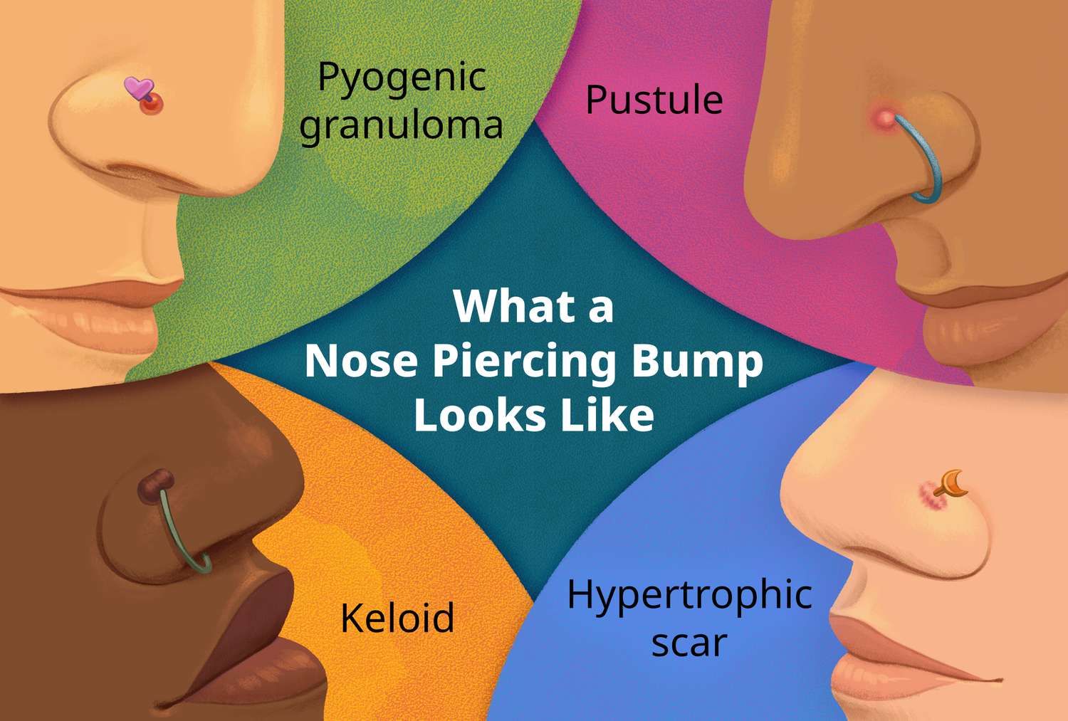 how to get rid of a piercing bump on nose