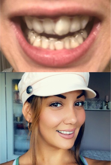 dr smile aligner