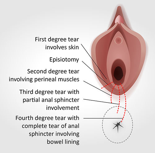 3rd degree perineal tear pictures