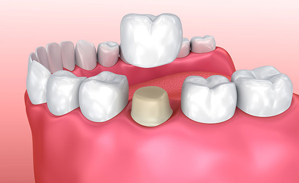 dental crowns specialist maple ridge