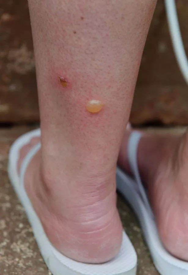 black fly bites spain treatment