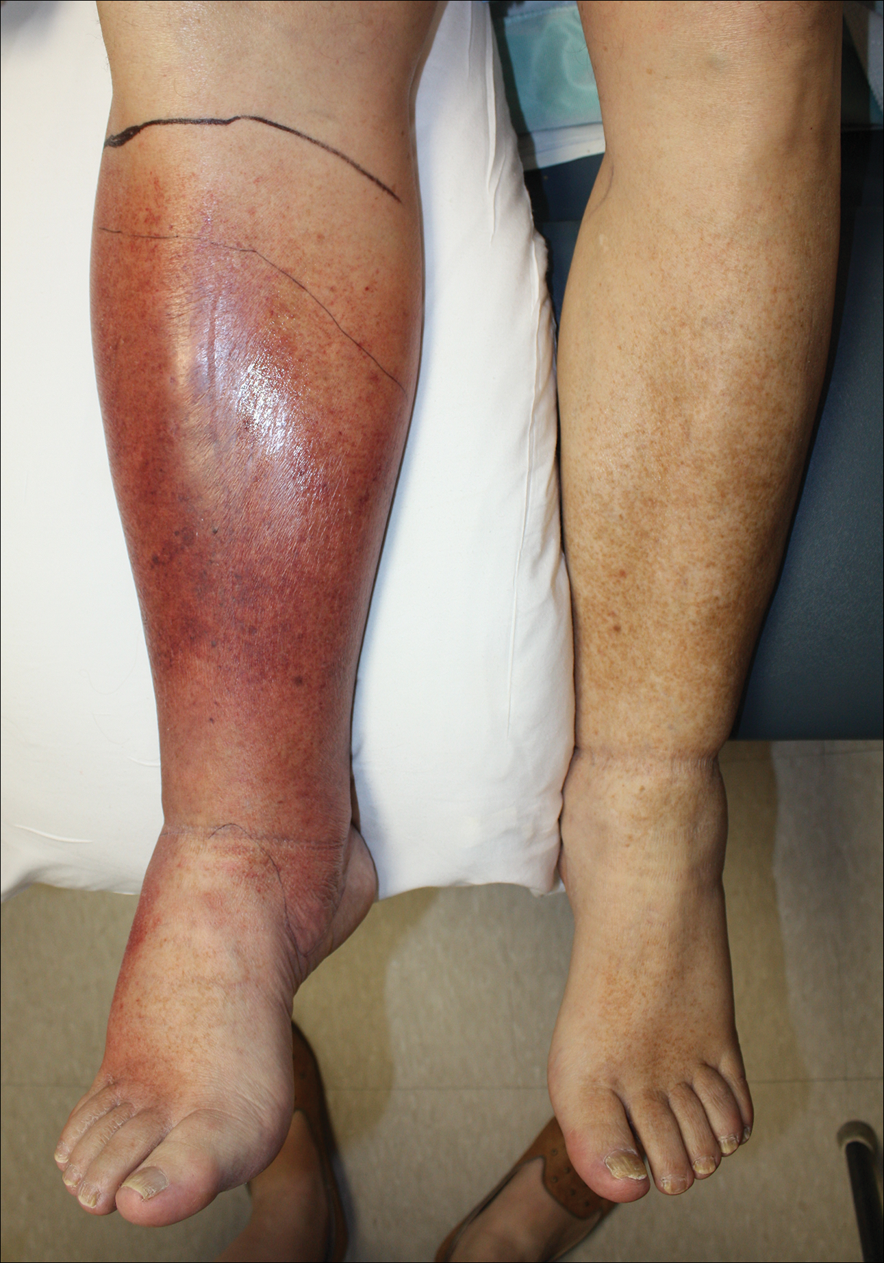 right lower extremity cellulitis icd 10
