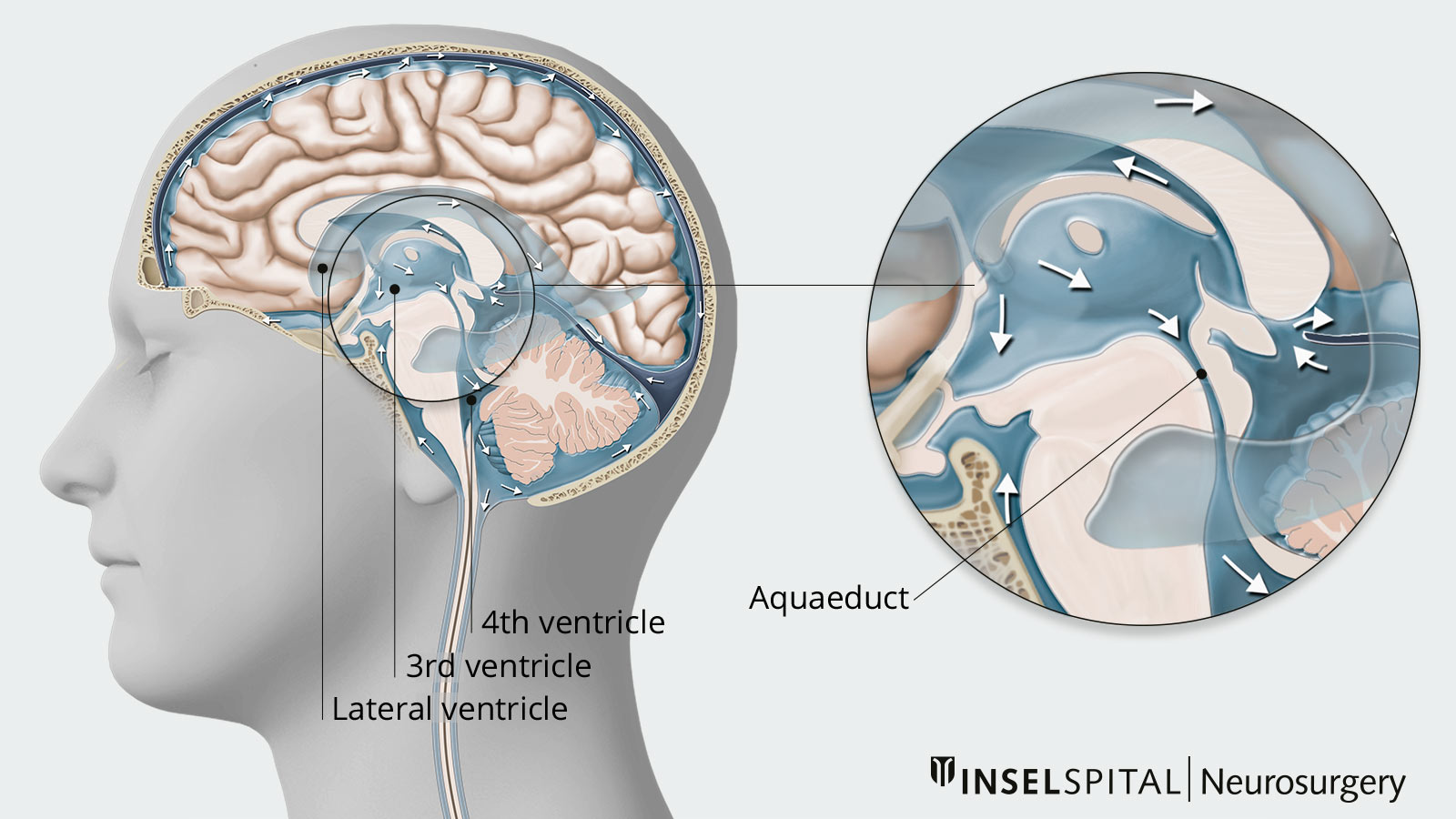 cerebral aqueduct stenosis