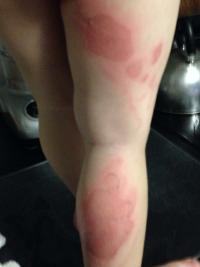 chemical burn from huggies