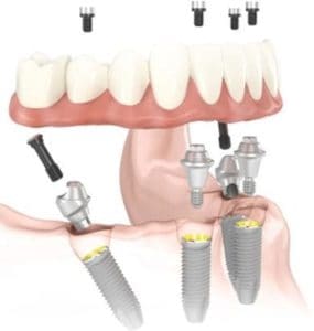 clearchoice dental implant center atlanta reviews