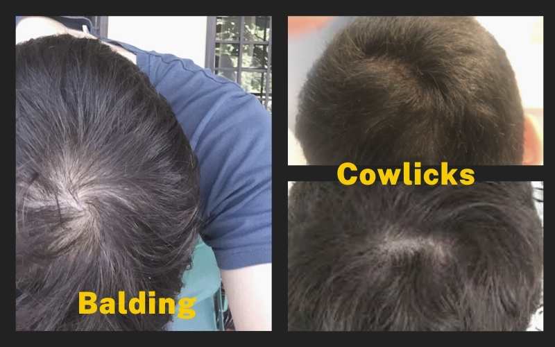 cowlick or balding