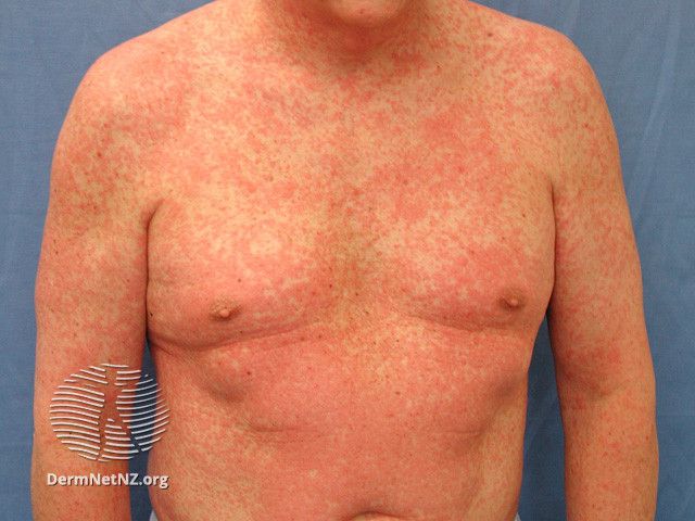 pictures of lamotrigine rash