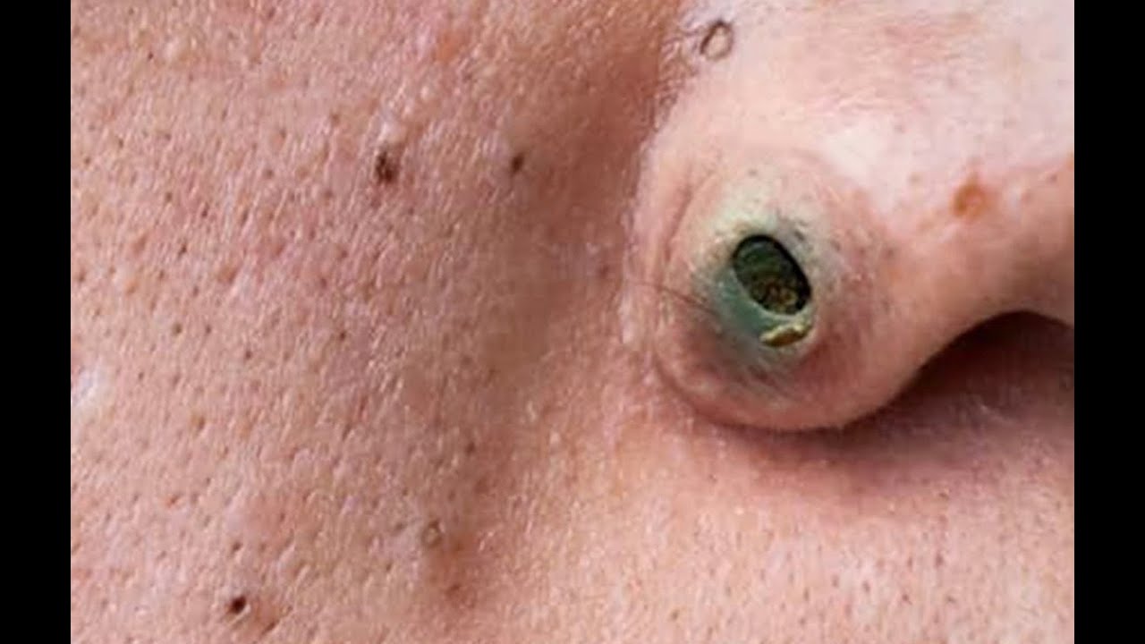 massive blackheads on nose and lips 2022