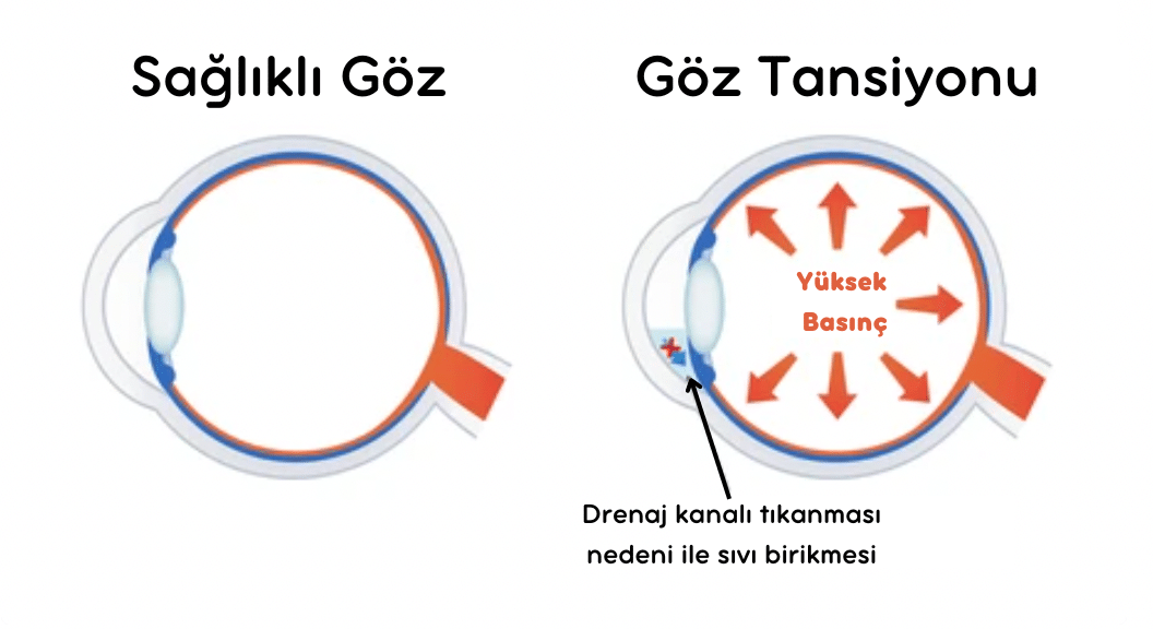 göz tansiyonu ingilizce