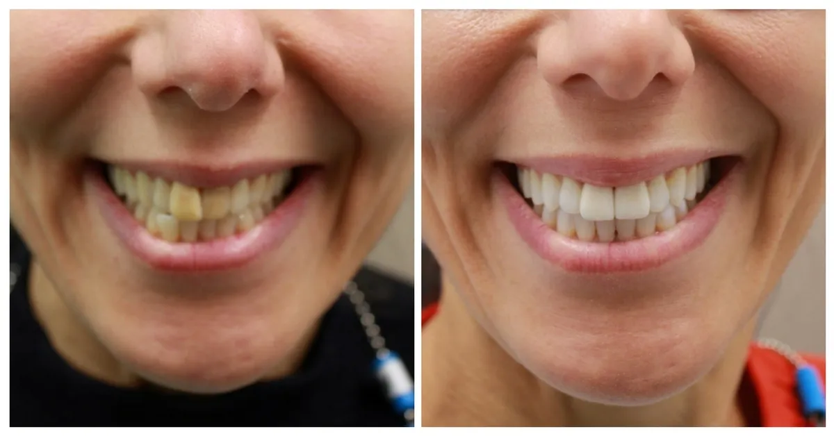 invisalign konya