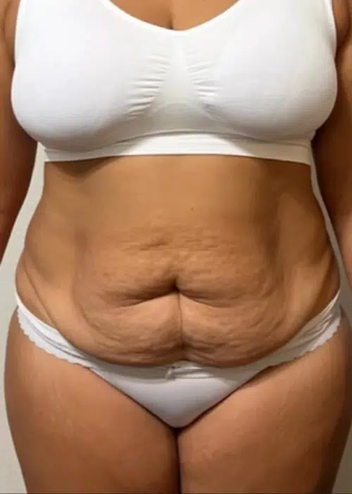 mia aesthetics tummy tuck