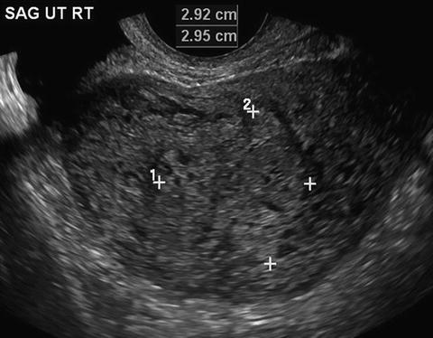 molar pregnancy radiology