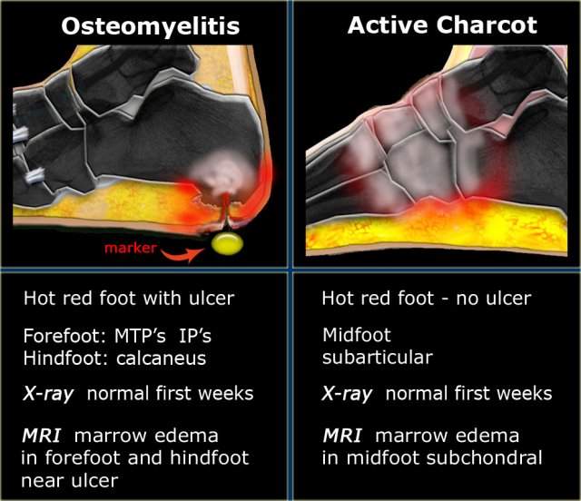 neuropathic joint radiology