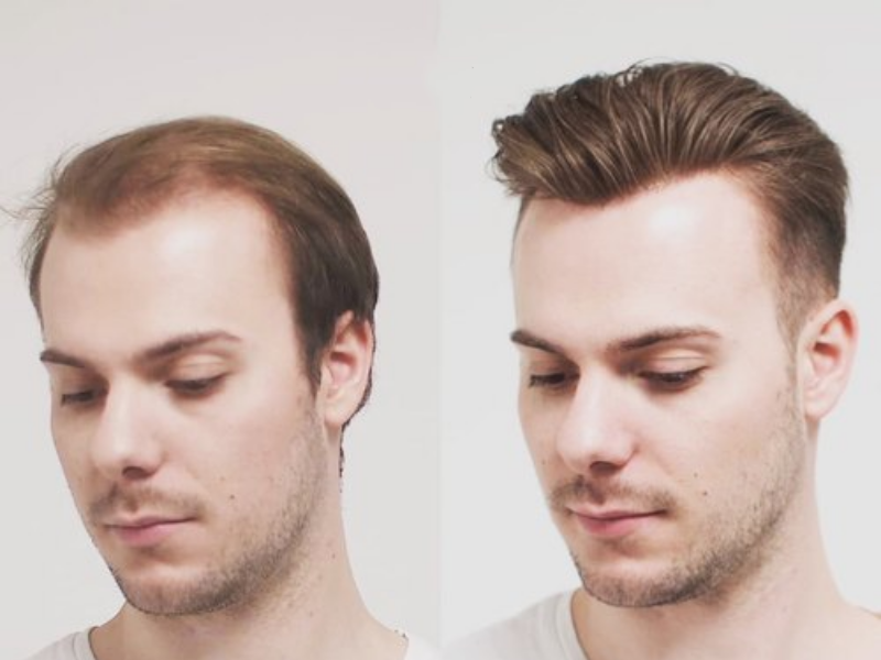 non surgical hair replacement in pune