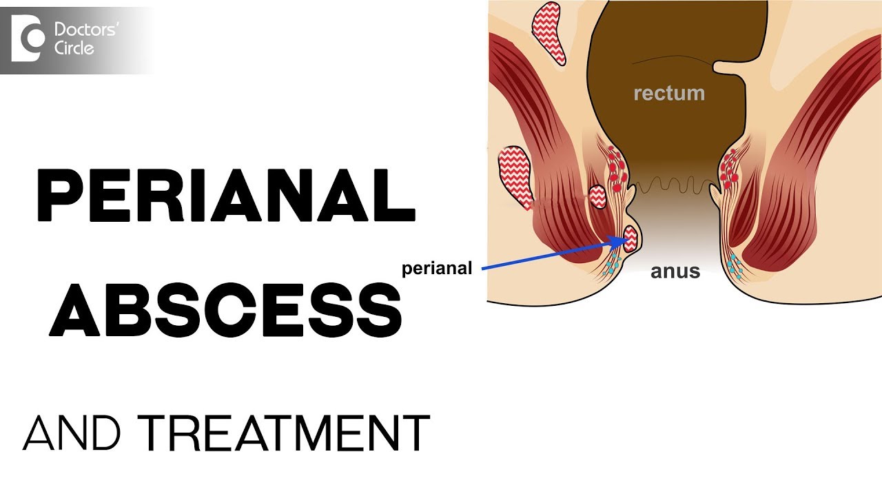 perianal abscess icd