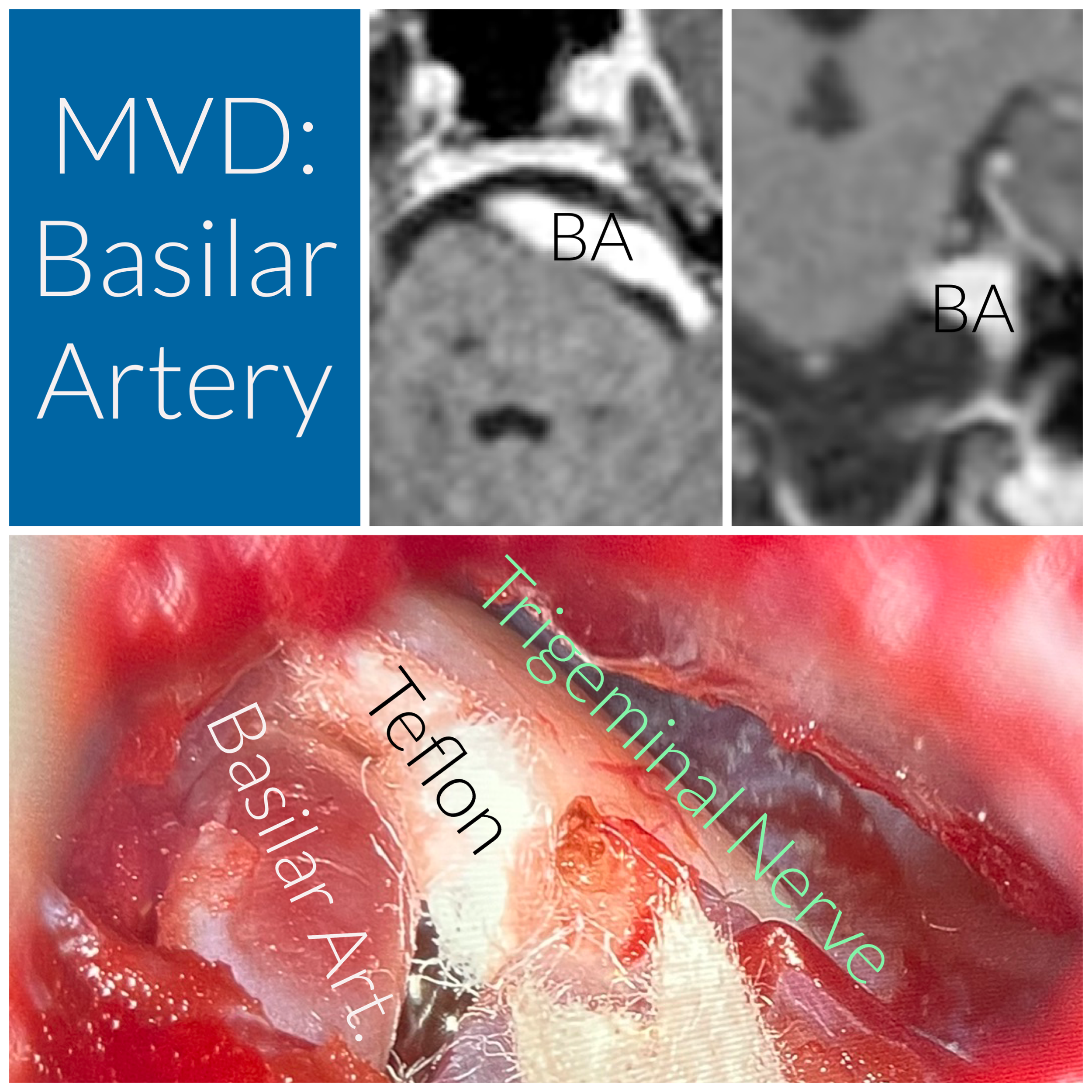 rapid mvd