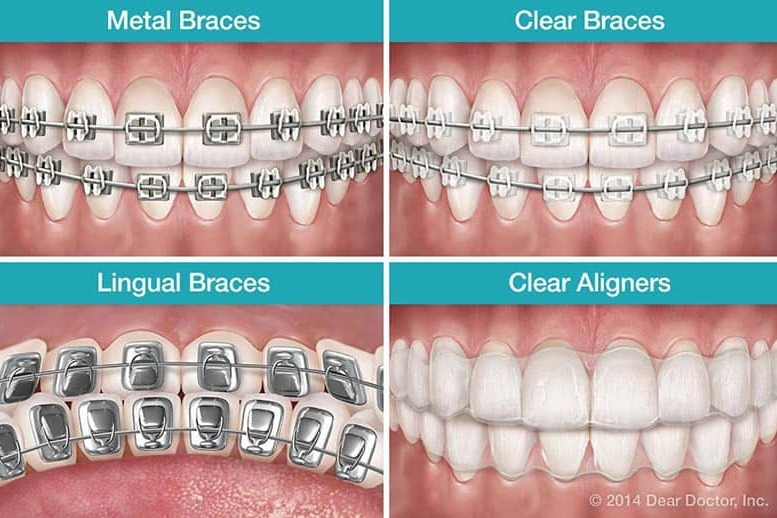 teeth braces images