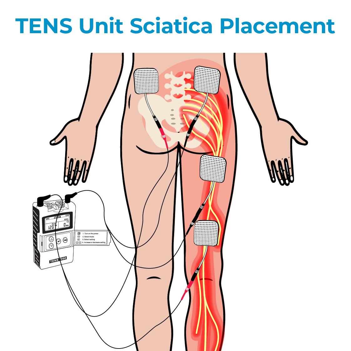 tens for sciatica