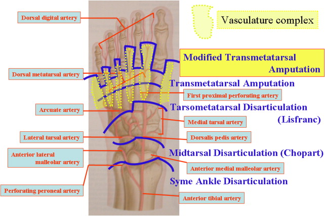 transmetatarsal meaning